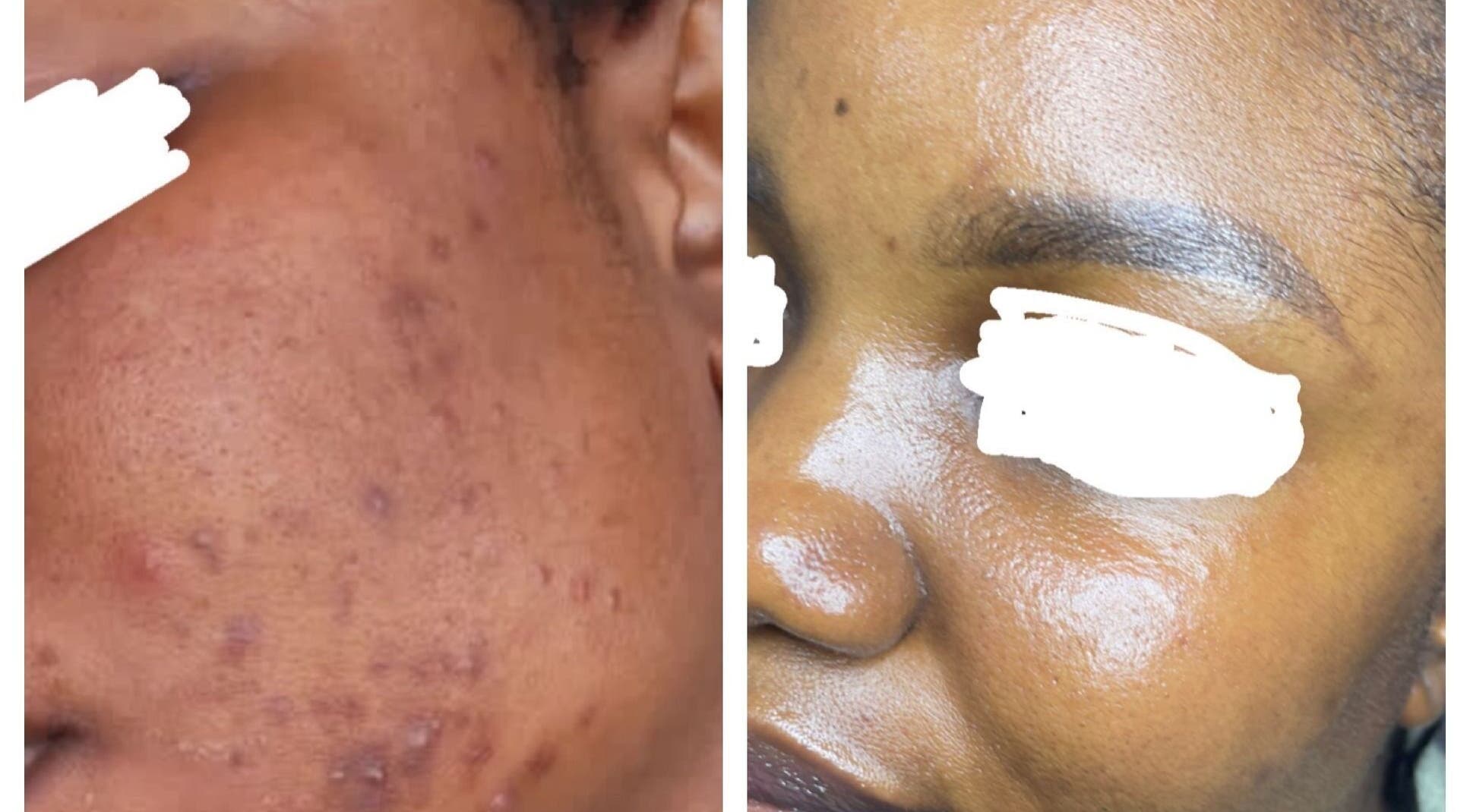 Before and after skin transformation at Zeekarh Cosmetics in Leeds, England, GB.