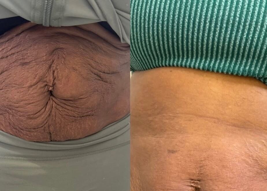 Before and after skin treatment at Balanced Sculpt in Birmingham, England, GB showing clear improvement.