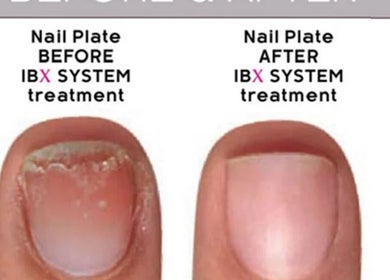 Before and after IBX System treatment at Aspire Nail Care Studio in Greenwood Village, Colorado, US.