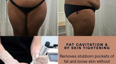 Fat cavitation and skin tightening at Glow Aura UK in Gravesend, England, GB enhances body contours effectively.