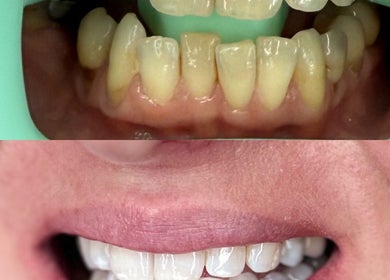 Before and after dental improvement at Chobham Aesthetics, Chobham, England, GB showcasing a bright smile.