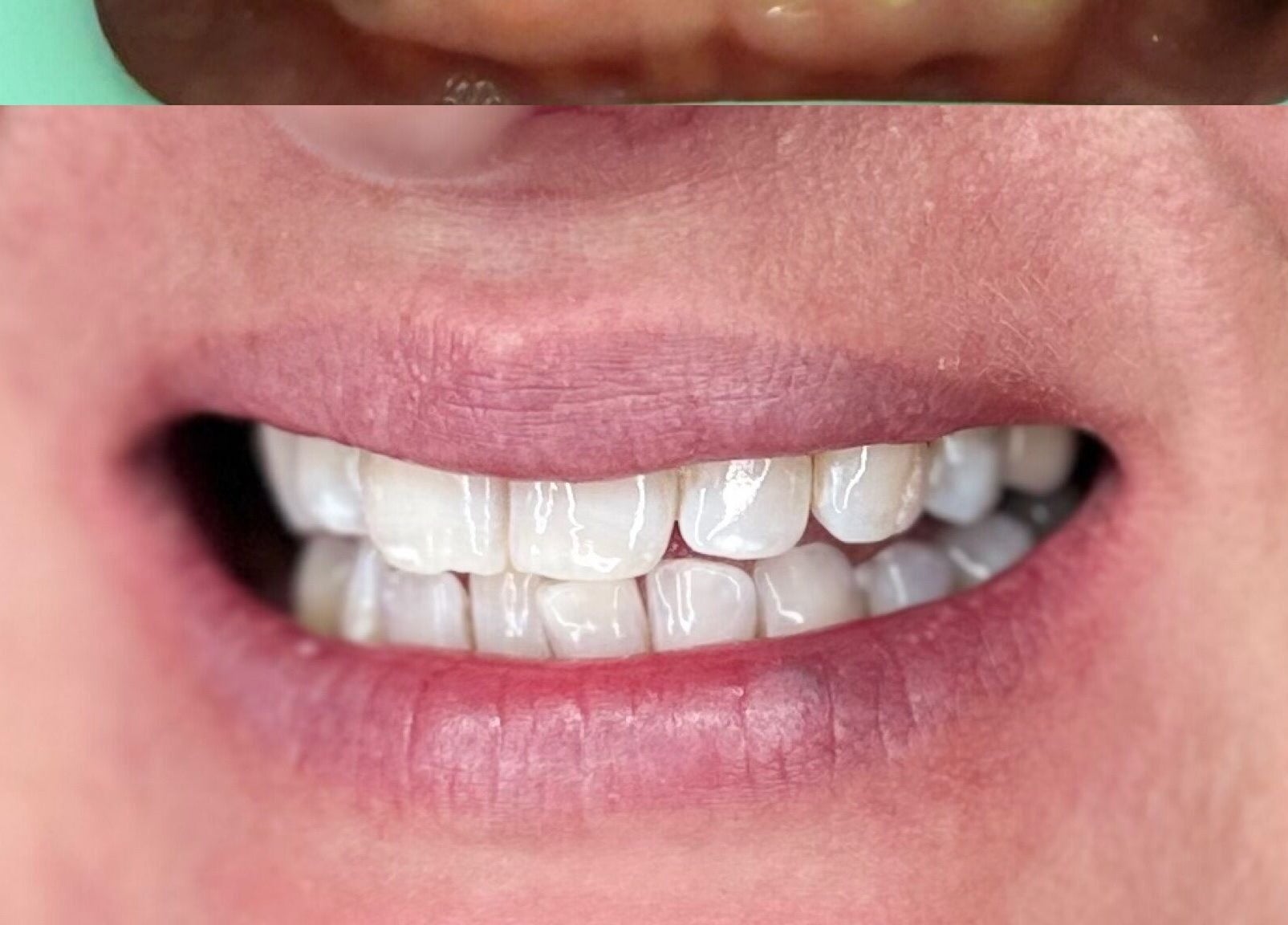 Before and after dental care at Chobham Aesthetics, Chobham, England, GB highlighting a bright healthy smile.