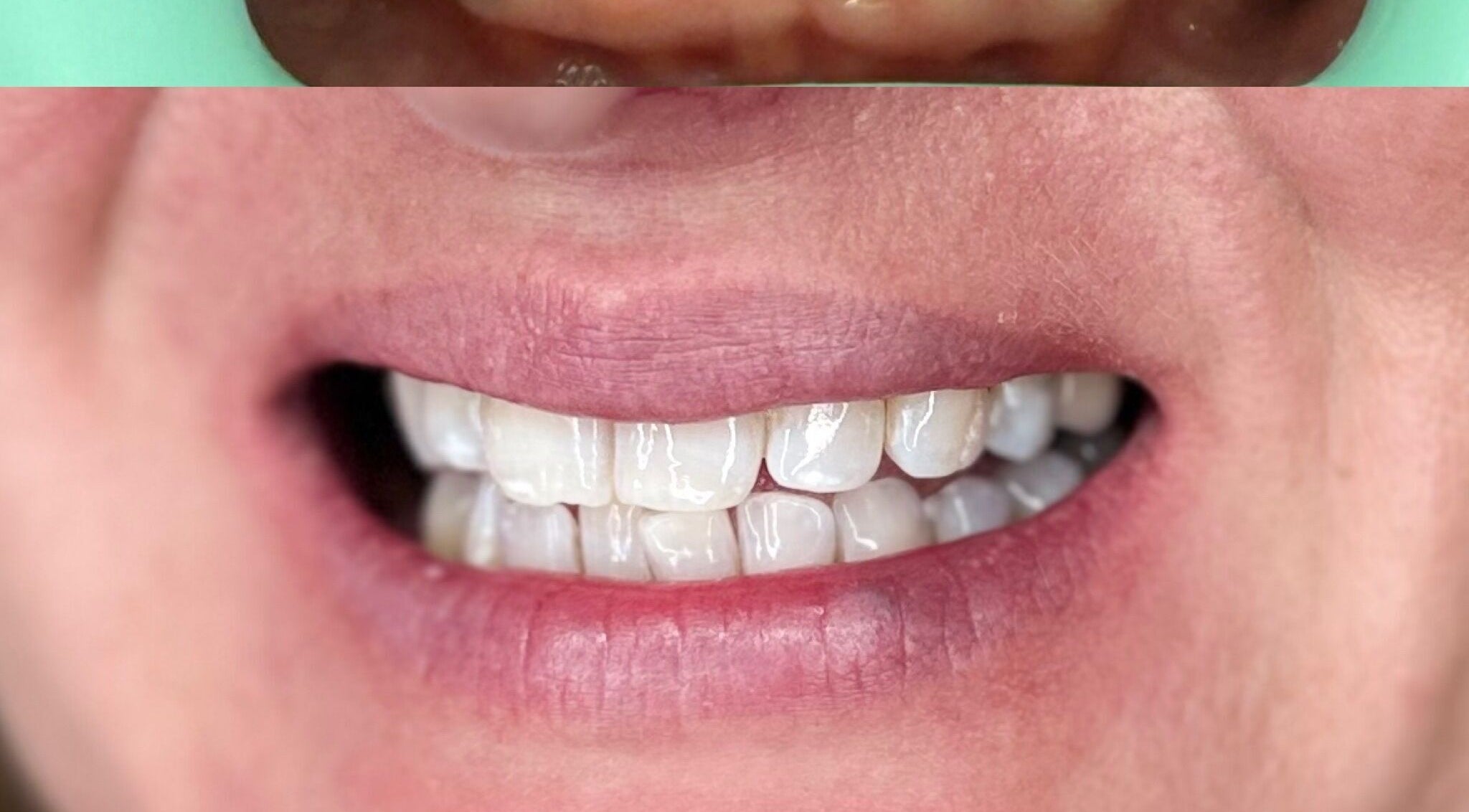 Before and after dental care at Chobham Aesthetics, Chobham, England, GB highlighting a bright healthy smile.