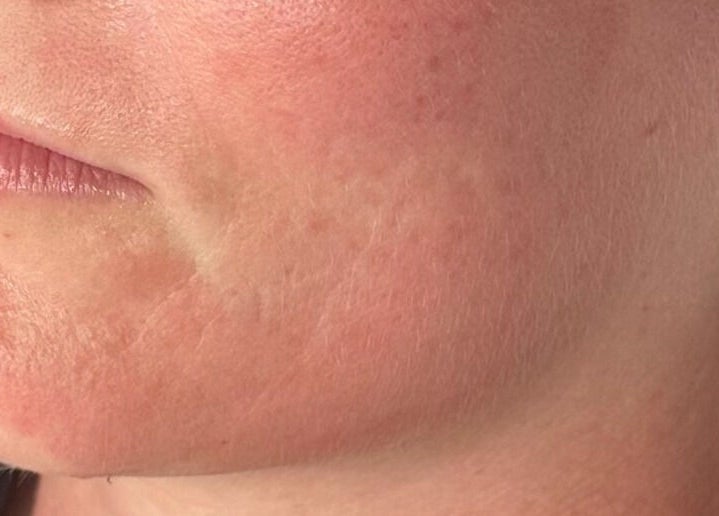 Close-up of smooth facial skin after treatment at The Pretty Skin Society, Warana, Queensland, AU.