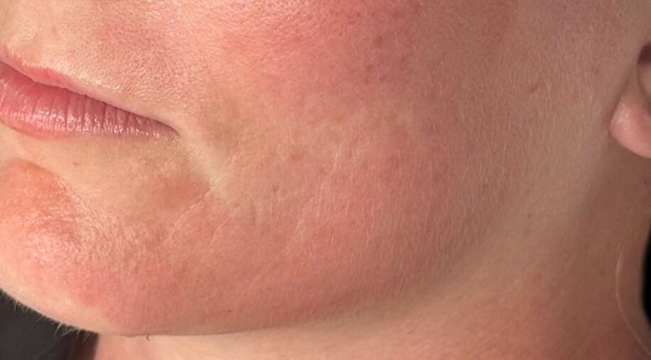 Close-up of smooth facial skin after treatment at The Pretty Skin Society, Warana, Queensland, AU.