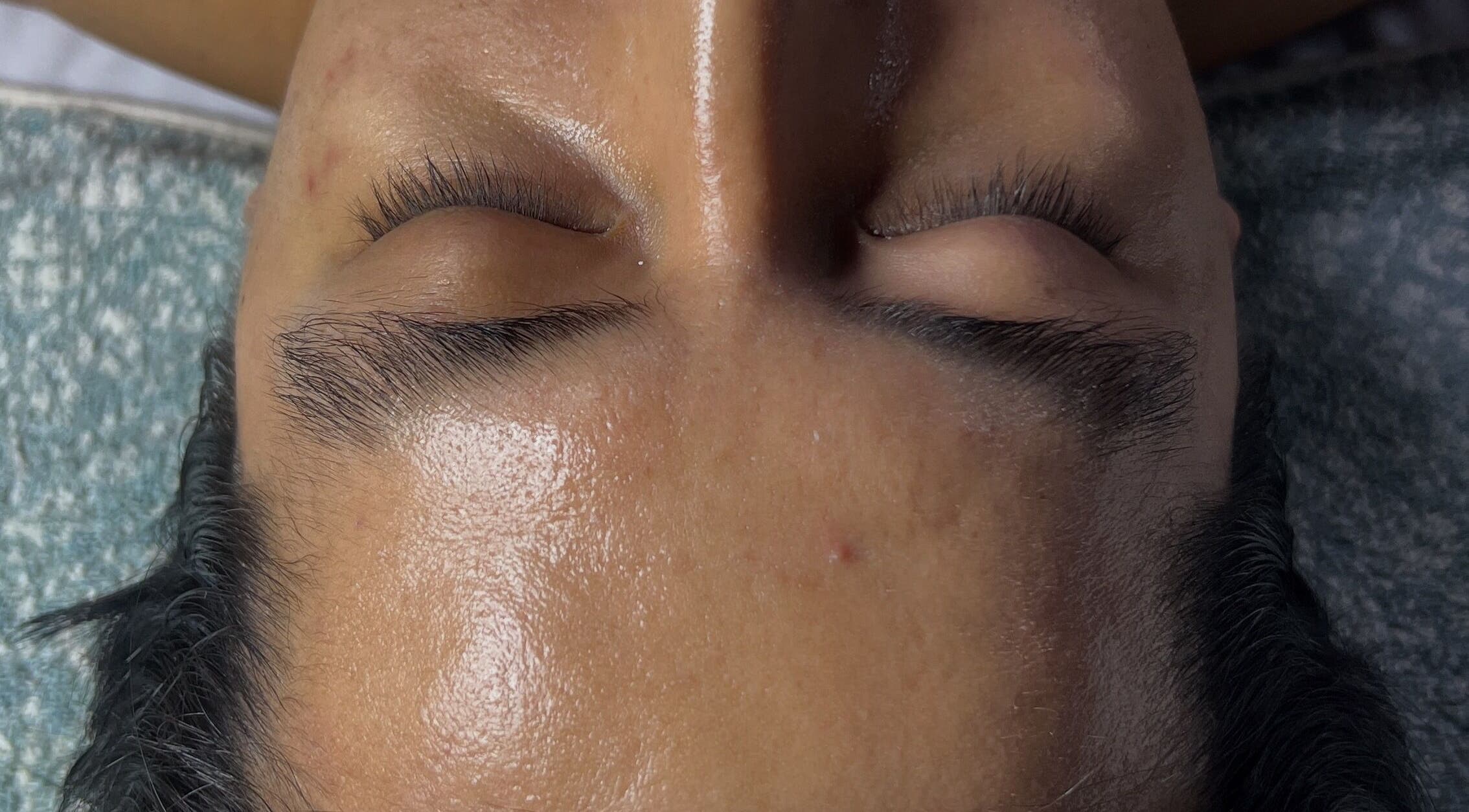 Tratamiento facial en Cosmiatra Ariana Ruilova, Samborondón, Guayas, EC, mostrando piel limpia y cuidada.