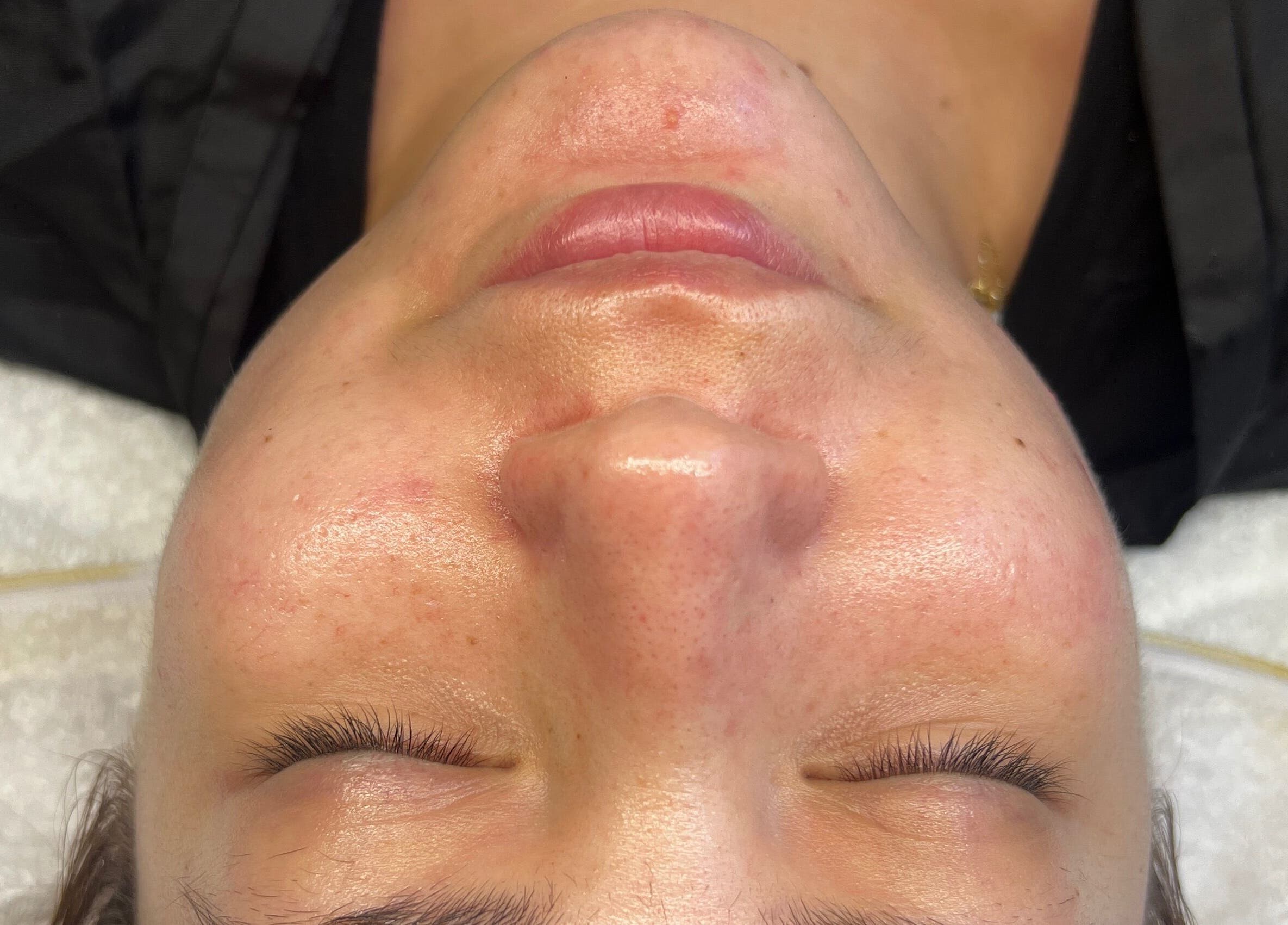 Rostro descansado tras tratamiento facial en Cosmiatra Ariana Ruilova, Samborondón, Guayas, EC.