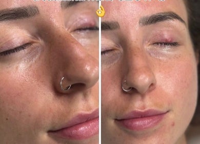 Close-up of a face with smooth skin after treatment at James Aesthetics, Northampton, England, GB.