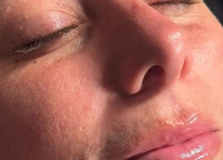 Facial treatment at James Aesthetics, Northampton, England, GB, showing smooth, rejuvenated skin.