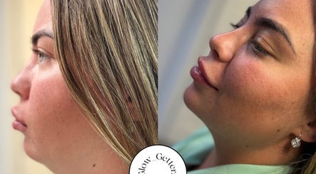 Before-after beauty treatment at Glow Getters, Ballyfermot, County Dublin, IE, showcasing enhanced skin glow.