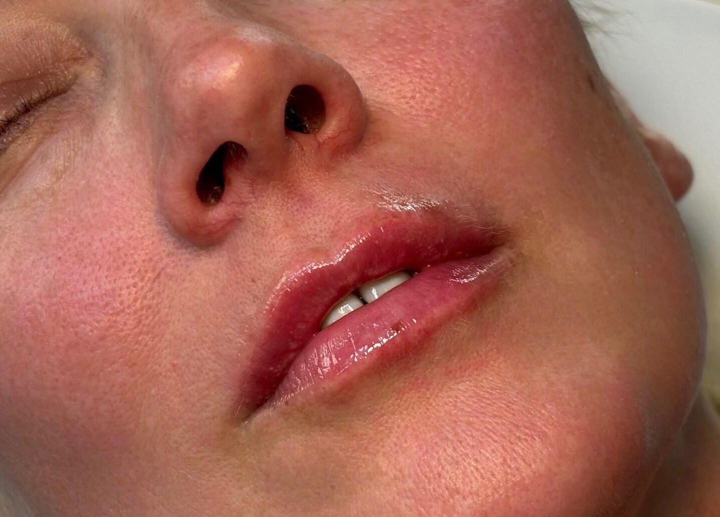 Close-up of smooth, radiant skin after treatment at Glow Getters, Ballyfermot, County Dublin, IE.