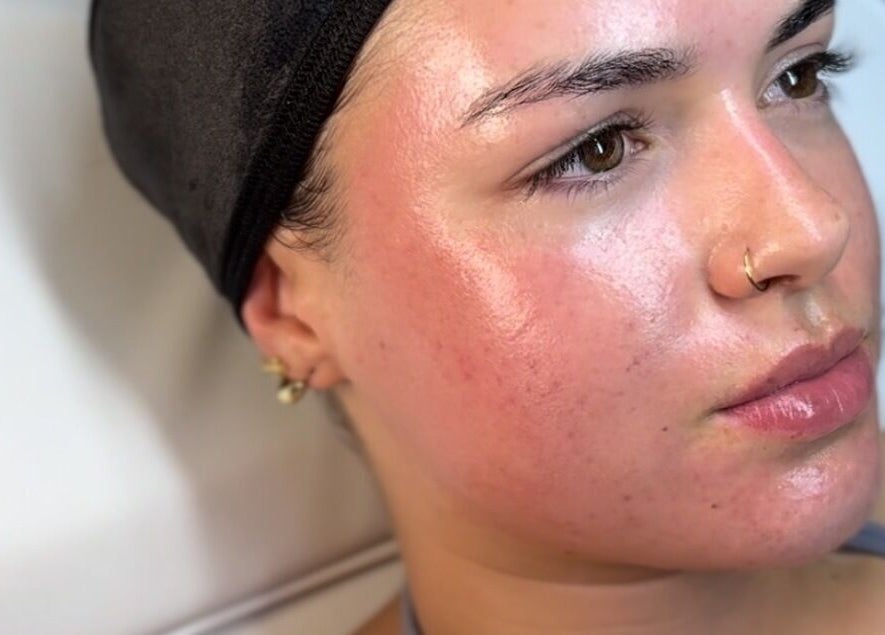 Close-up of a glowing face post-treatment at Glow Getters, Ballyfermot, County Dublin, IE.