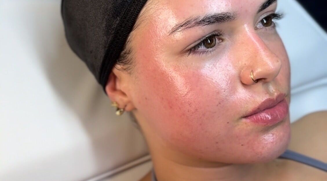 Close-up of a glowing face post-treatment at Glow Getters, Ballyfermot, County Dublin, IE.