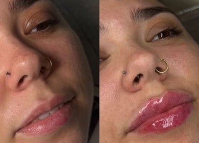 Lip enhancement before and after at Aesthetic Invasion, Liverpool, England, GB. Noticeable volume and gloss.