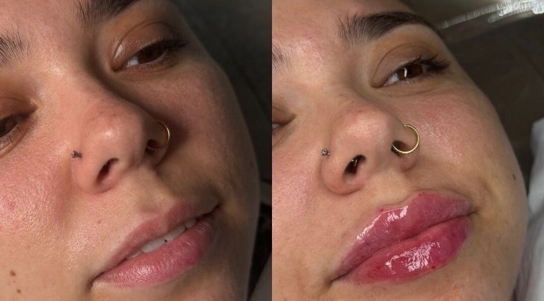 Lip enhancement before and after at Aesthetic Invasion, Liverpool, England, GB. Noticeable volume and gloss.