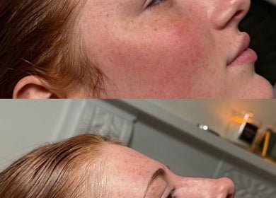 Before and after facial treatment at Aesthetic Invasion, Liverpool, England, GB, showing clear skin results.