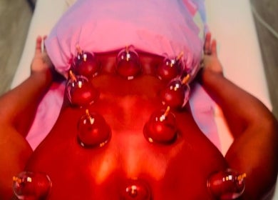 Cupping therapy session at Pain Management Clinic LDN, Ilford, England, GB.