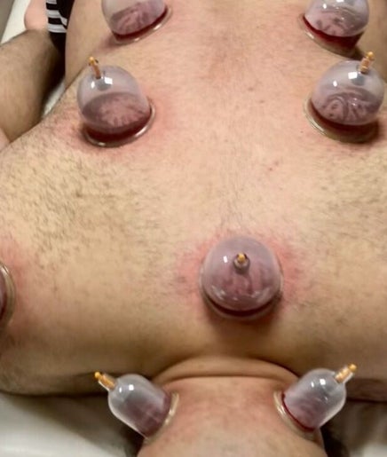 Cupping therapy on a back at Pain Management Clinic LDN, Ilford, England, GB.