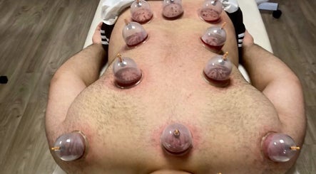 Cupping therapy session at Pain Management Clinic LDN in Ilford, England, GB.
