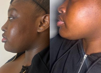 Skin enhancement at The Shape of You, London, England, GB showcasing visible facial improvements.