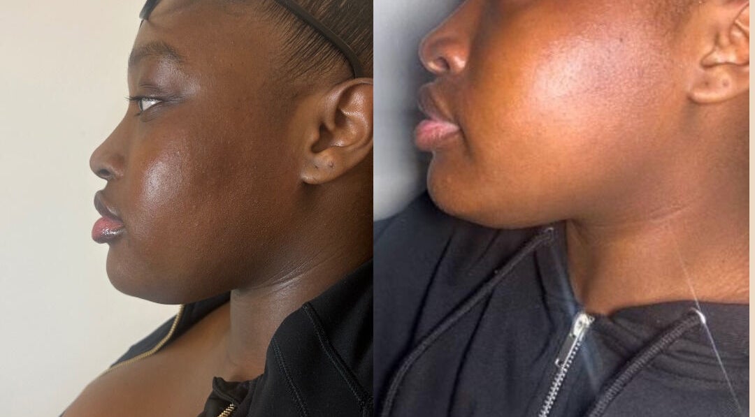 Skin enhancement at The Shape of You, London, England, GB showcasing visible facial improvements.