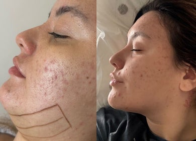 Before and after acne treatment at The Shape of You, London, England, GB, showcasing clear skin results.