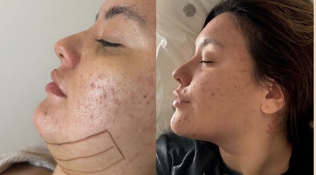 Before and after acne treatment at The Shape of You, London, England, GB, showcasing clear skin results.