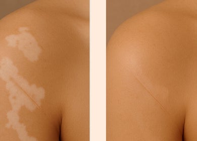 Before and after skin treatment at EnhancedbyMursal, Toronto, Ontario, CA, showing improved skin tone.