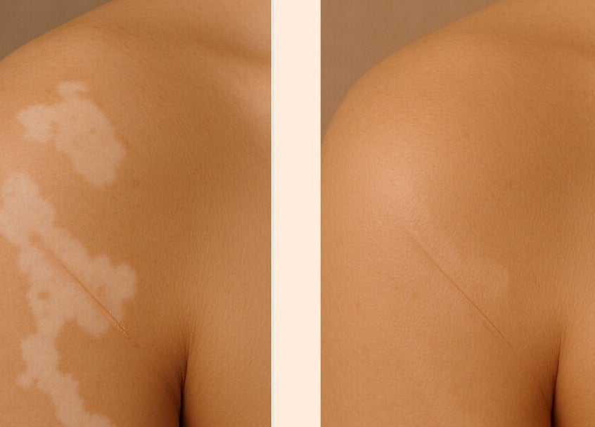 Before and after skin treatment at EnhancedbyMursal, Toronto, Ontario, CA, showing improved skin tone.