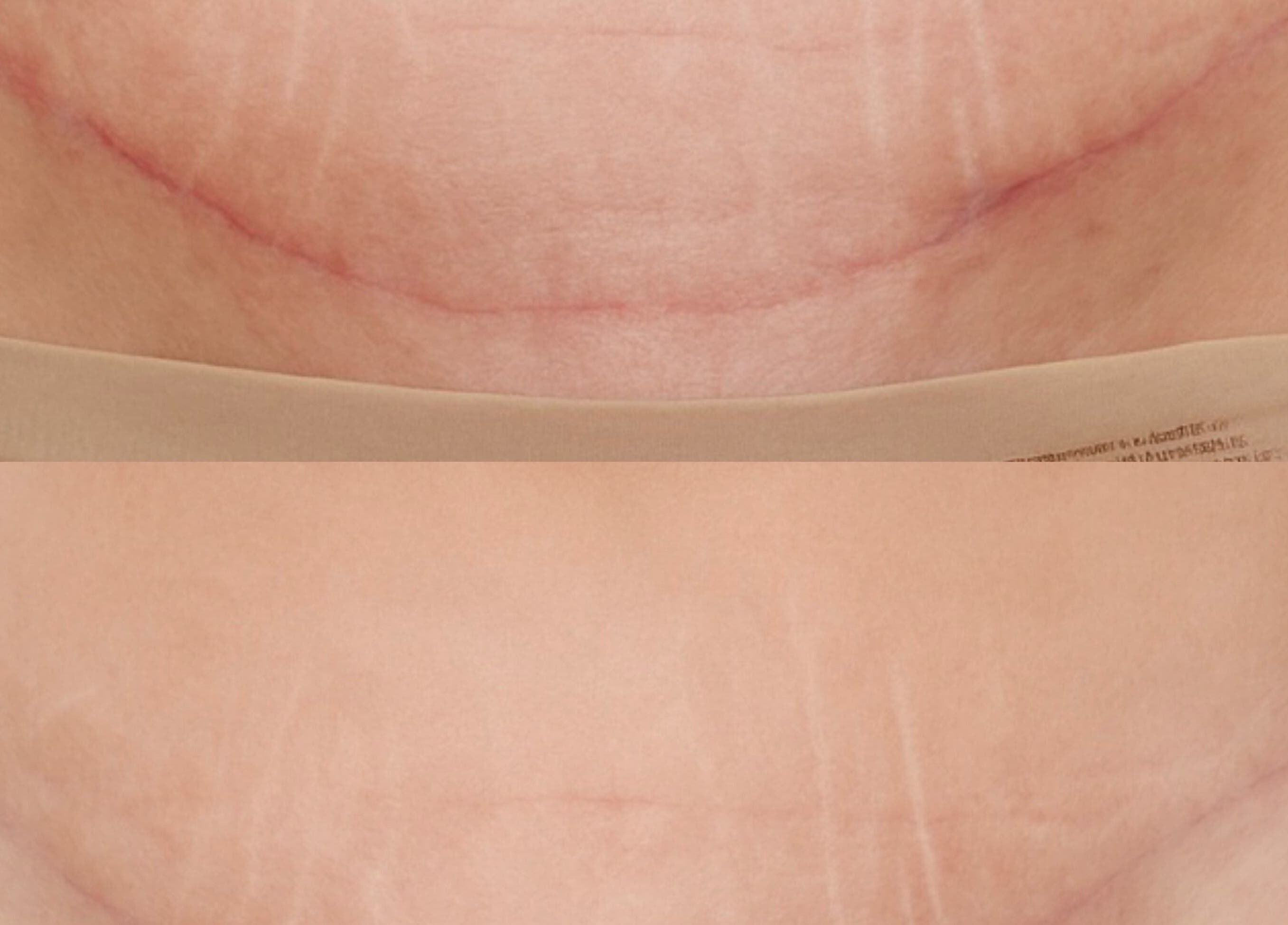 Before and after scar treatment at EnhancedbyMursal in Toronto, Ontario, CA. Visible improvement shown.