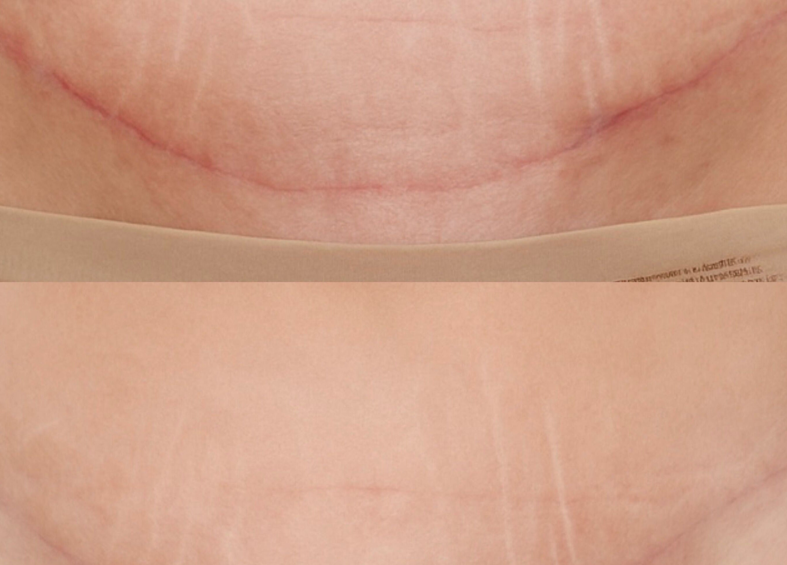 Before and after scar treatment at EnhancedbyMursal in Toronto, Ontario, CA. Visible improvement shown.