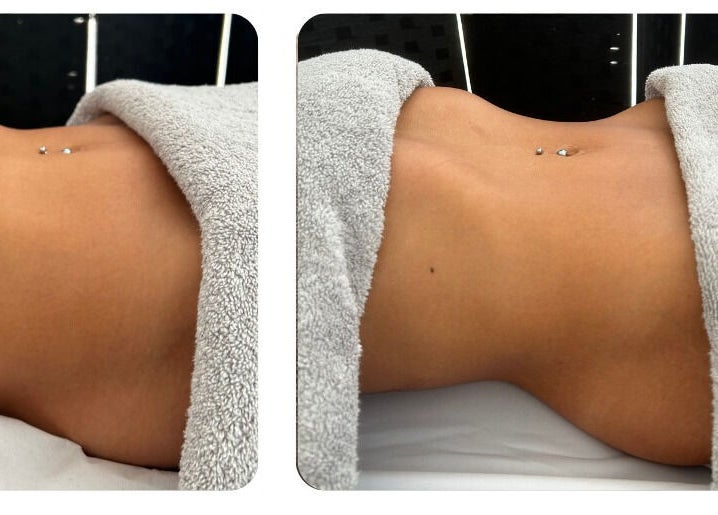 Body contouring treatment at Bod by Fod in Totton, England, GB, showcasing before and after results.