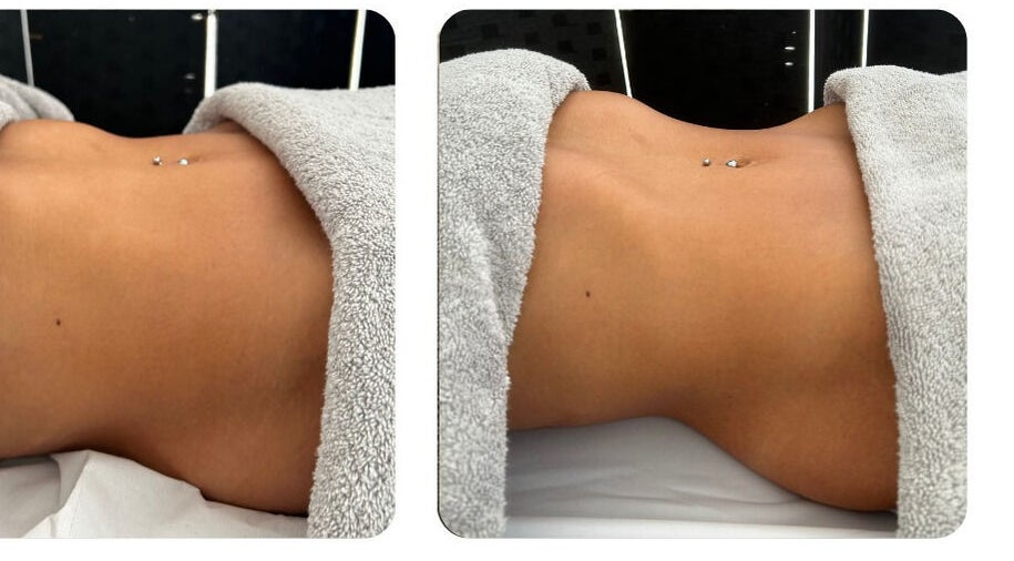 Body contouring treatment at Bod by Fod in Totton, England, GB, showcasing before and after results.
