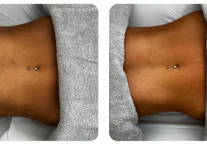 Before and after body toning at Bod by Fod, located in Totton, England, GB.