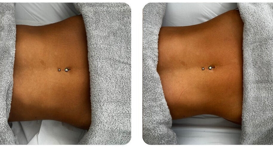 Before and after body toning at Bod by Fod, located in Totton, England, GB.