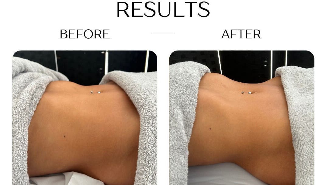 Before and after body sculpting at Bod by Fod Cyprus, Episkopi Lemesou, Limassol, CY.