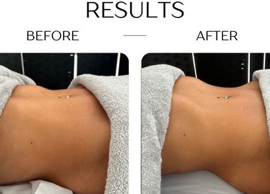 Before and after body sculpting at Bod by Fod Cyprus, Episkopi Lemesou, Limassol, CY.