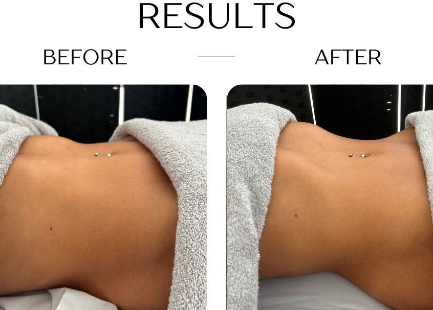Before and after body sculpting at Bod by Fod Cyprus, Episkopi Lemesou, Limassol, CY.