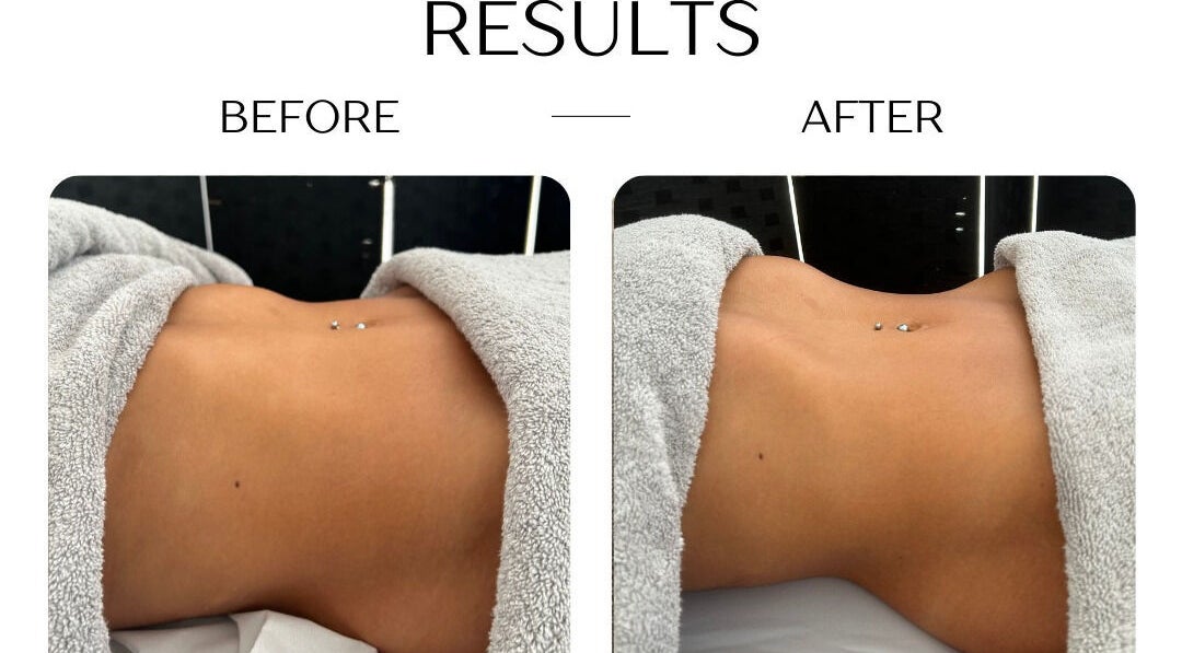 Before and after body sculpting at Bod by Fod Cyprus, Episkopi Lemesou, Limassol, CY.