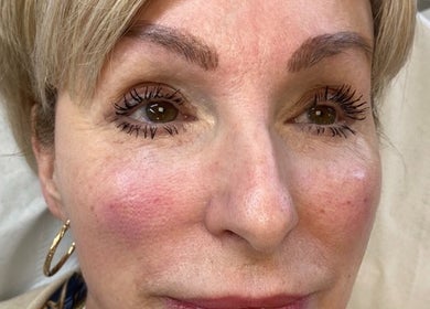 Radiant complexion post-treatment at Get The Glo Wellness & Beauty, Dorridge, England, GB.