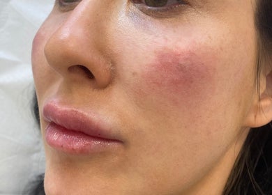 Facial treatment results at Get The Glo Wellness & Beauty in Dorridge, England, GB showing smooth, glowing skin.