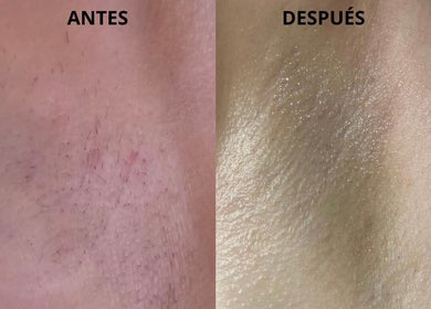 Comparación de piel antes y después del tratamiento en Beauty Láser, Montornès Del Vallès, Catalunya, ES.