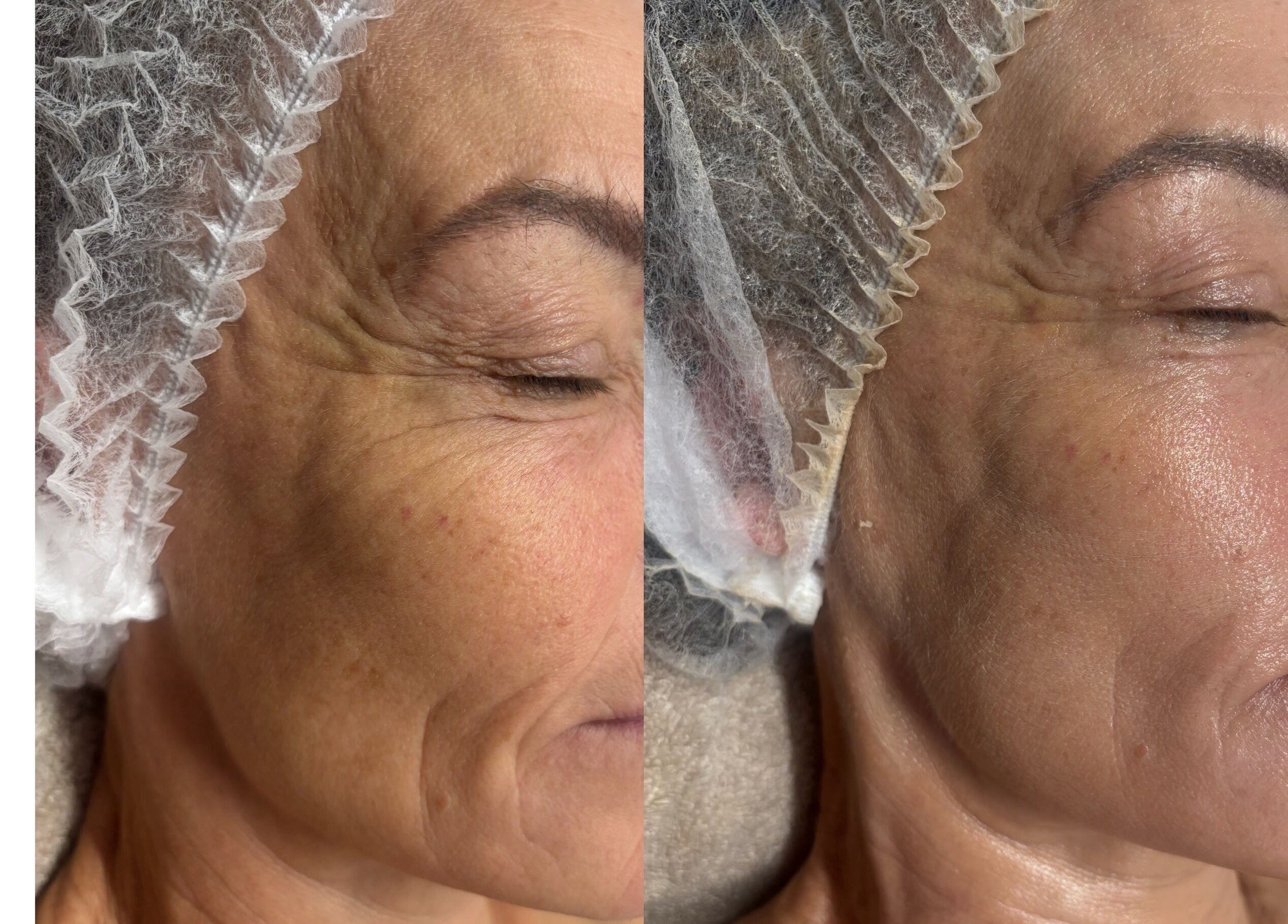 Before and after facial treatment at Revive Skin & Aesthetic Clinic, Abergavenny, Wales, GB.