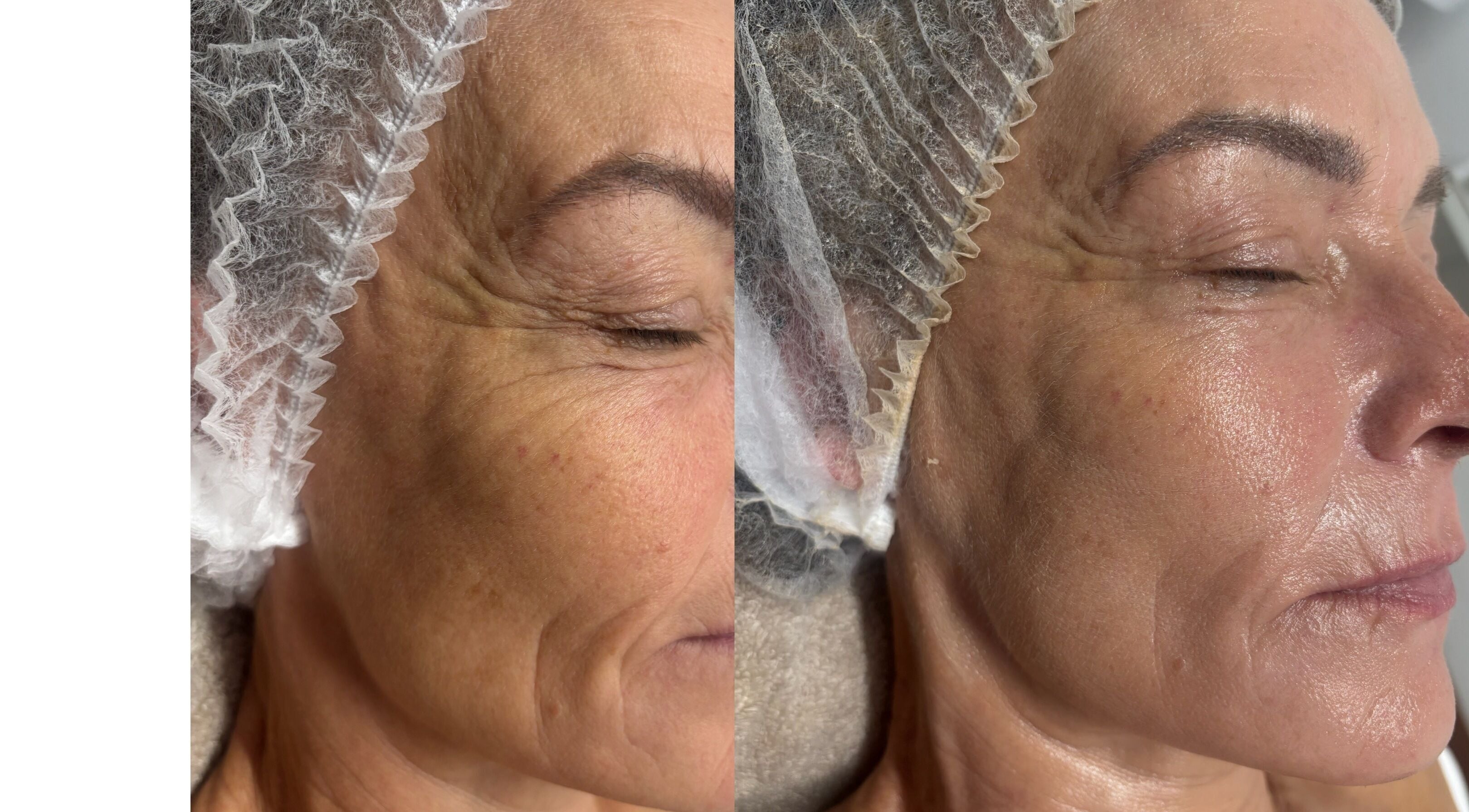 Before and after facial treatment at Revive Skin & Aesthetic Clinic, Abergavenny, Wales, GB.