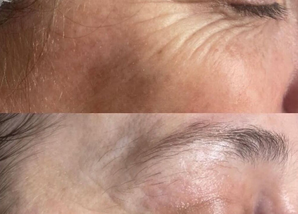 Before and after skin treatment at Revive Skin & Aesthetic Clinic in Abergavenny, Wales, GB showing wrinkle reduction.