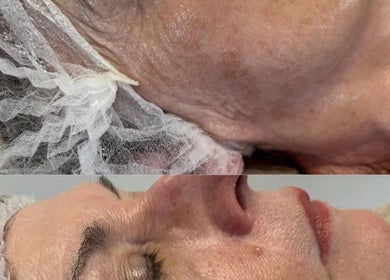 Facial treatment results at Revive Skin & Aesthetic Clinic, Abergavenny, Wales, GB, showcasing smoother skin.