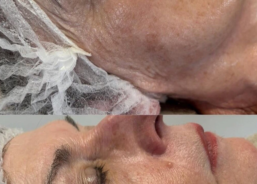 Facial treatment results at Revive Skin & Aesthetic Clinic, Abergavenny, Wales, GB, showcasing smoother skin.