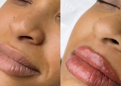 Before and after lip enhancement at MYAB London, Stanmore, England, GB showcasing natural enhancement results.