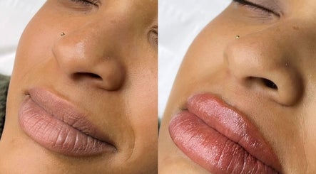 Before and after lip enhancement at MYAB London, Stanmore, England, GB showcasing natural enhancement results.