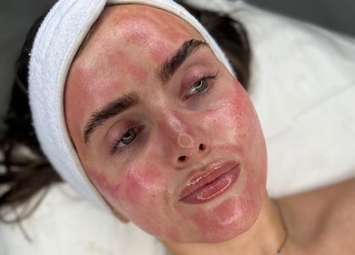 Facial treatment at Derma Touch Skin Clinic in Widnes, England, GB showcasing radiant skin results.
